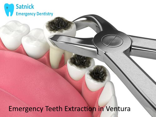 Emergency tooth extraction in Ventura