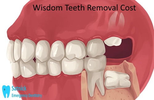 Wisdom Teeth Removal Cost in Ventura